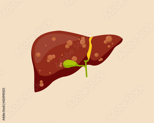 Damaged human Unhealthy fatty liver organ human healthcare concept.