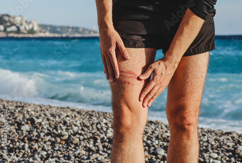 A jellyfish sting burn on a man's leg, on the beach photo
