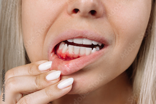 Bild auf Leinwand Ulcerative stomatitis on the gums