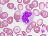 White blood cell in blood smear, analyze by microscope