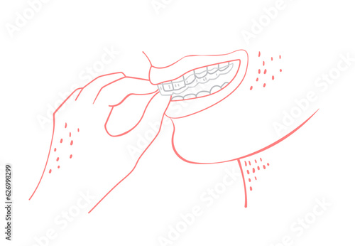 Orthodontic silicone trainer. Invisible braces retainer. Vector illustration