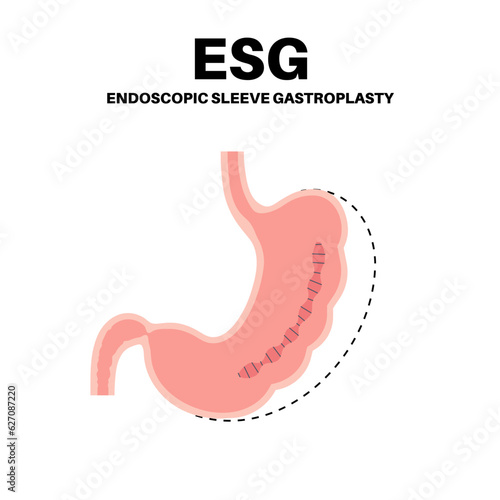 Endoscopic sleeve gastroplasty