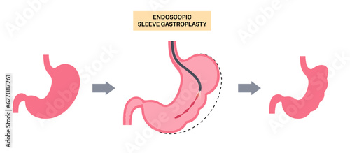Endoscopic sleeve gastroplasty