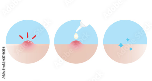 How to use acne pimple treatment for inflammatory acne vector icon set illustration on white background. Step of use, direction for use acne cream, gel and lotion absorbing papule on skin face.