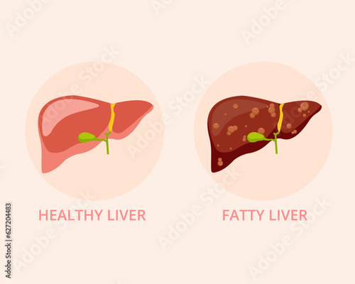 Fatty liver and healthy liver Healthy and damaged human internal organ