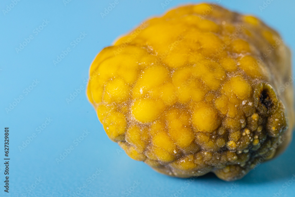 Gallstones,multiple cholesterol stone in gallbladder with cholecystitis