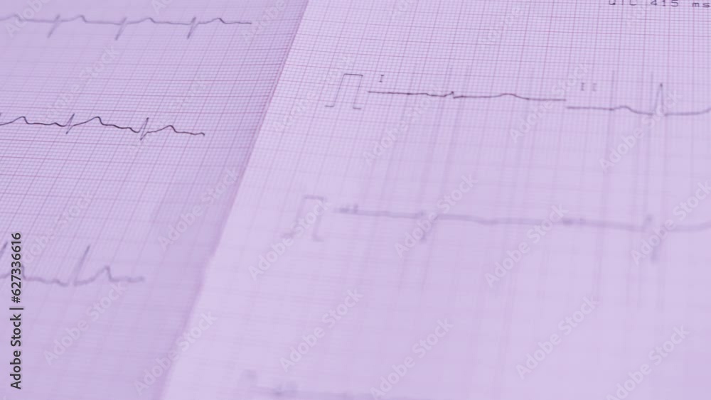 Detailed electrocardiography histogram captured on a paper roll, showcasing vital cardiac data for medical examinations and analysis. Detailed electrocardiography histogram captured on a paper roll, showcasing vital cardiac data for medical examinations and analysis.