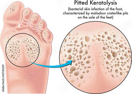 Medical illustration of symptoms of pitted keratolysis, a bacterial skin infection of the foot.