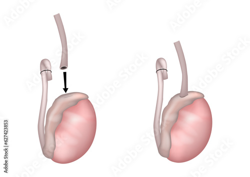 Vasoepididymostomy or epididymovasostomy surgical procedures. Vasoepididymostomy Anastomosis. Operation on the testicles Microsurgical Process.