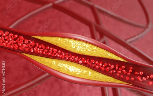 Hyperlipidemia. Blocked artery concept and human blood vessel as a disease with cholesterol fat buildup clogging. Clogged arteries, Cholesterol plaque in the artery. 3D Rendering photo