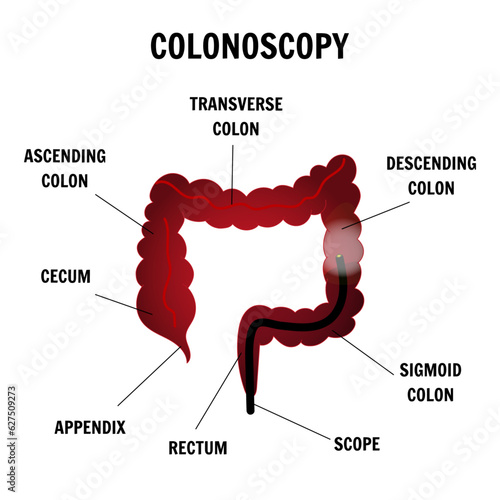 Medical infographic of gut colonoscopy in vector illustration 