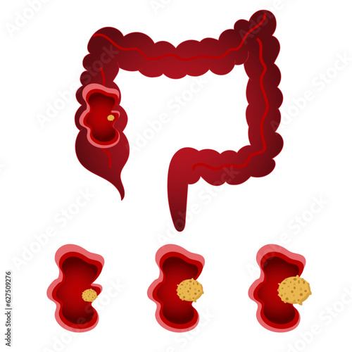 Medical cartoon of gut disease polyps, and cancer in vector illustration 
