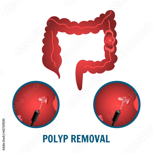 Medical cartoon of gut colonoscopy and polyp removal in vector illustration 