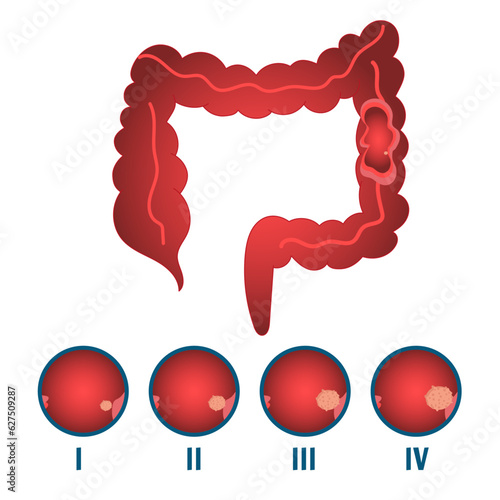 Medical infographic of stages polyp and cancer disease in vector illustration 