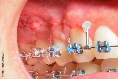 Close-up image capturing the consequences of using tight rubber bands or elastics on gums. Visible signs of inflammation and an implant site scar are depicted