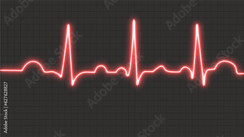 Electrocardiogram (ECG) is normal. standard sinus rhythm. demonstrates the P wave, which depolarizes the atria, the QRS complex, which depolarizes the ventricles, and the T wave, which repolarizes the