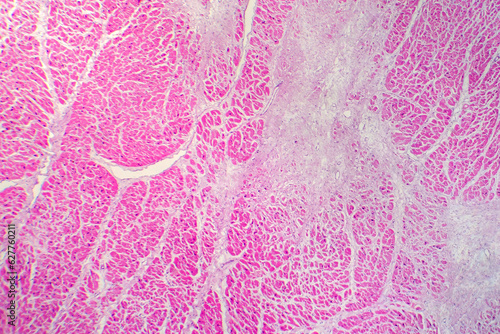 Papier peint Photomicrograph of myocardial infarction