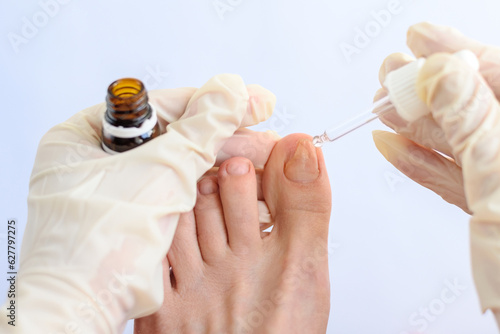 Onychomycosis. Patient applying treatment to treat nail fungus