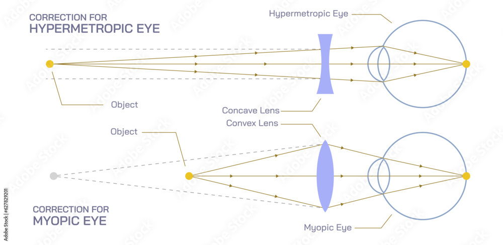 Difference between Hyperopia and myopia. The distant object becomes focused behind or in front of the retina. Making close or distant objects appear out of focus. Difference between Hyperopia and myopia. The distant object becomes focused behind or in front of the retina. Making close or distant objects appear out of focus.