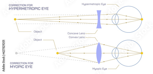 Difference between Hyperopia and myopia. The distant object becomes focused behind or in front of the retina. Making close or distant objects appear out of focus.