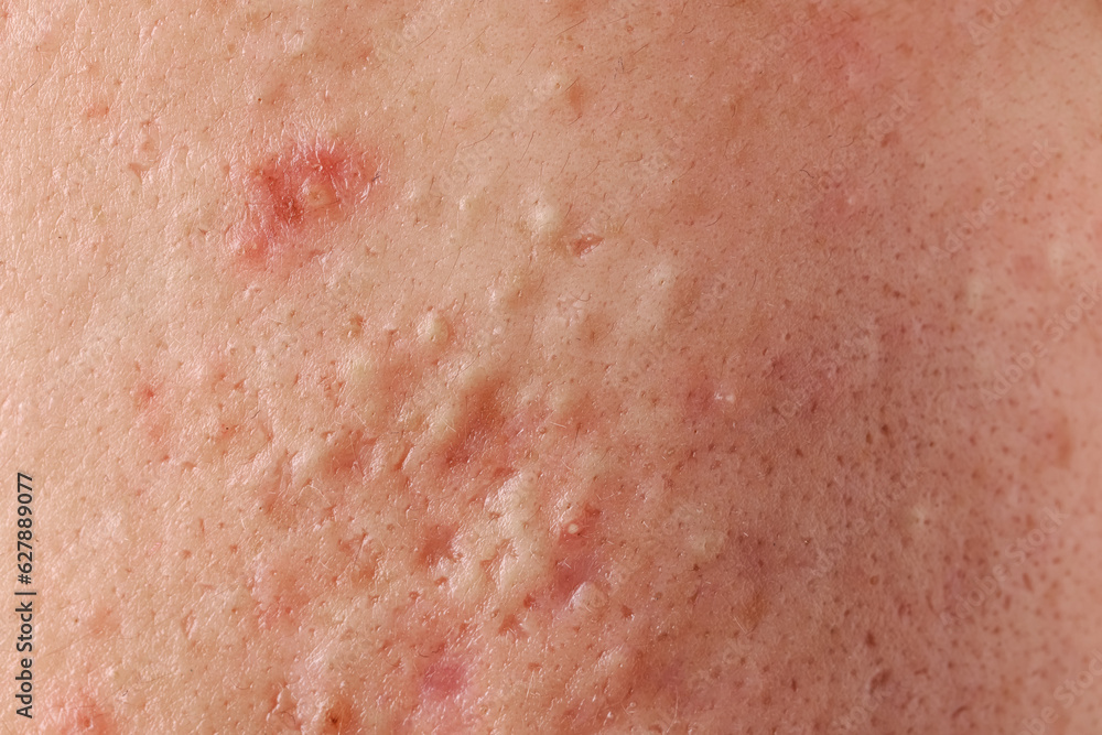 Fototapeta premium Young person with acne problem, closeup view of skin