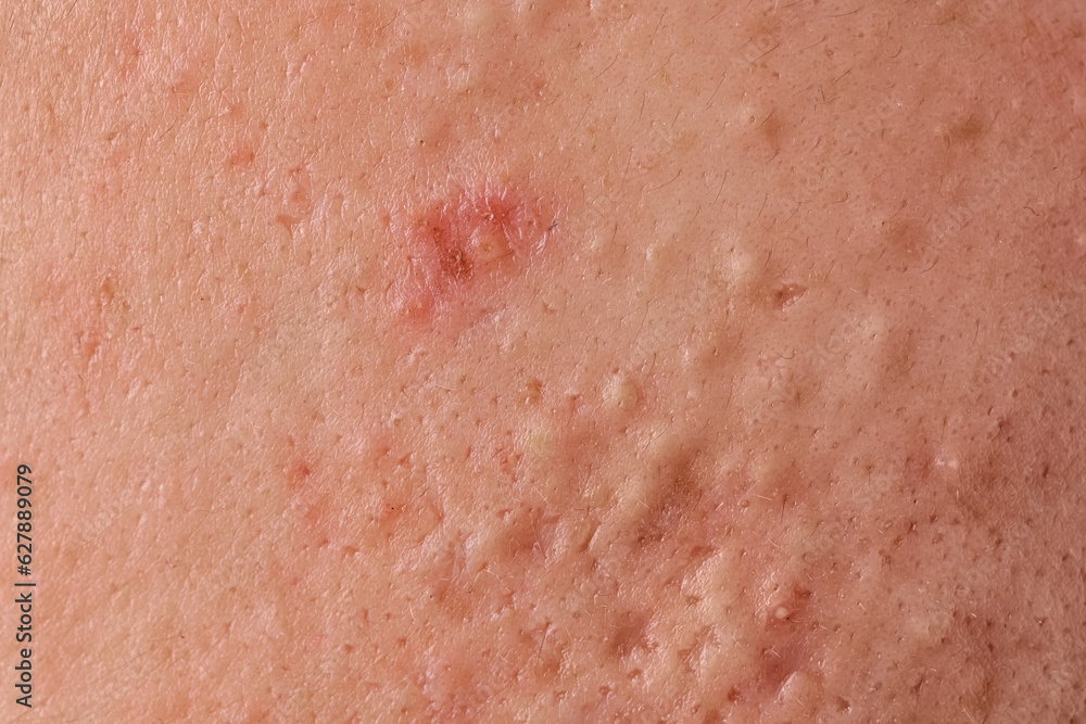 Fototapeta premium Young person with acne problem, closeup view of skin