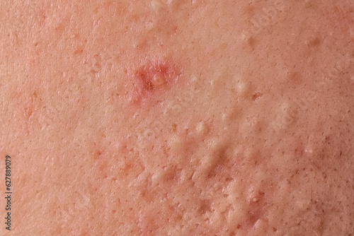Young person with acne problem, closeup view of skin photo