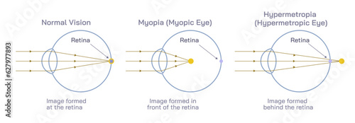 Difference between Hyperopia and myopia. The distant object becomes focused behind or in front of the retina. Making close or distant objects appear out of focus. photo