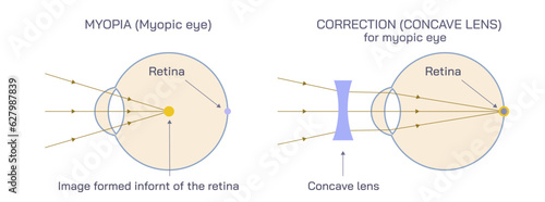 Difference between Hyperopia and myopia. The distant object becomes focused behind or in front of the retina. Making close or distant objects appear out of focus.