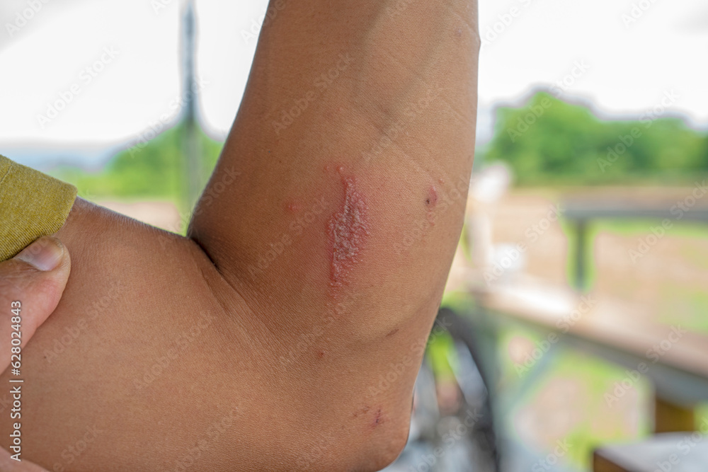 Fototapeta premium man arm with actual second degree burn