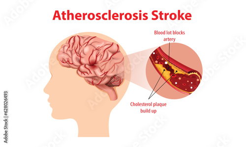 Stroke types set. Hemorrhagic and ischemic brain stroke. Damaged human brain, blocked and ruptured blood vessels. Emergency medical care. Flat vector illustration