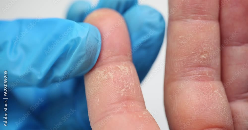 Peeling of palms and fingers of allergy. Fingers of a man with eczema