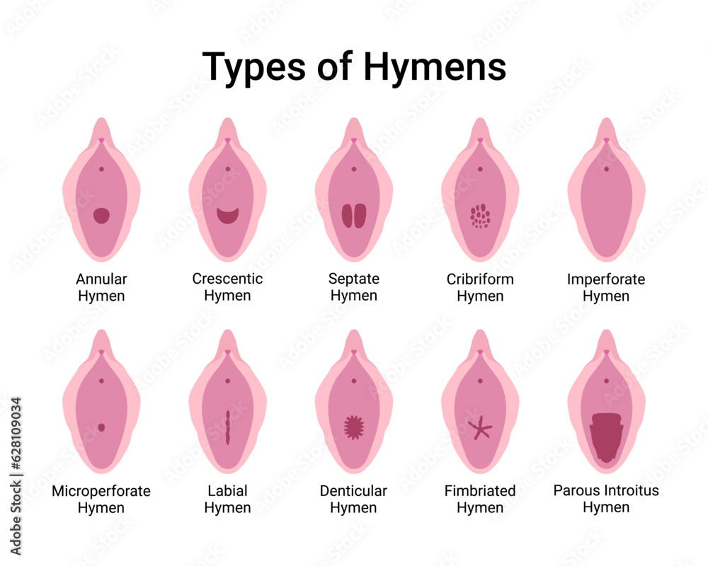 Types of Hymens Medical Vector Illustration Stock Vector | Adobe Stock
