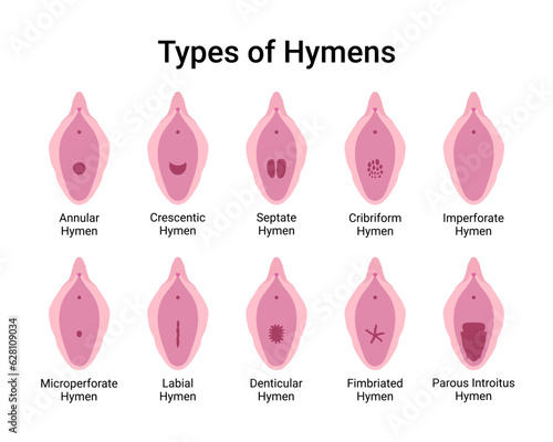 Types of Hymens Medical Vector Illustration