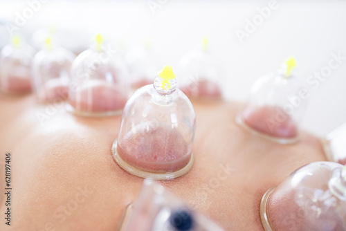 Traditional hijama treatment and therapy for healthy body.