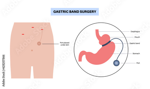 Gastric band poster