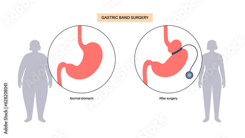 Gastric band poster