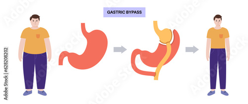 Gastric bypass surgery