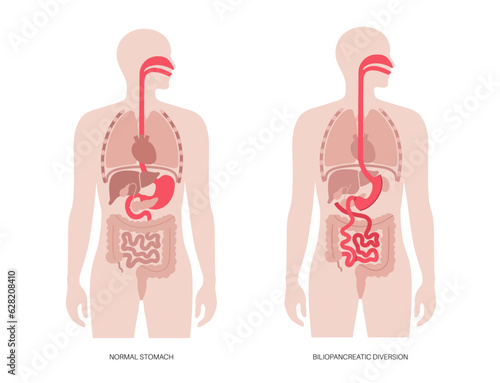 Biliopancreatic diversion procedure