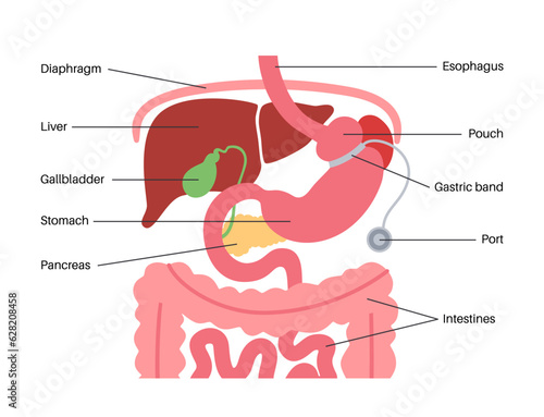 Gastric band poster