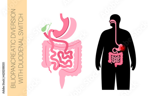 Biliopancreatic diversion procedure