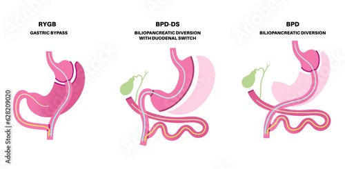 Bariatric surgery poster photo