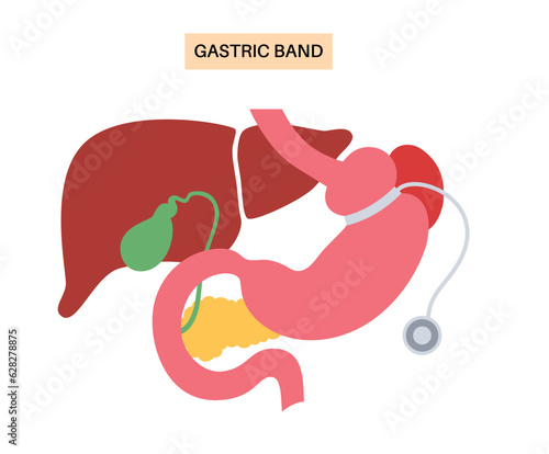 Gastric band poster