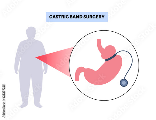 Gastric band poster