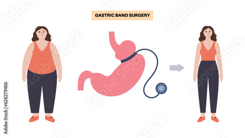 Gastric band poster