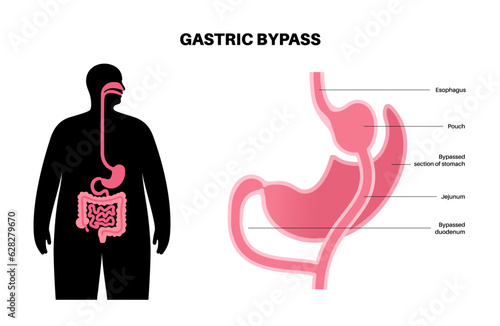 Gastric bypass surgery