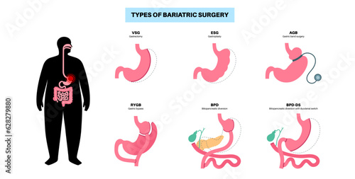 Bariatric surgery poster