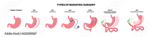 Bariatric surgery poster photo