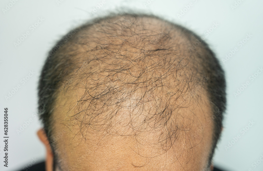 Close up of top view of baldness men's scalp. Baldness is related to your genes and male sex hormones. Close up of top view of baldness men's scalp. Baldness is related to your genes and male sex hormones.