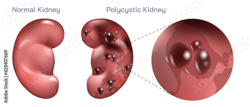 Polycystic kidney disease PKD. Chronic kidney failure, involves a gradual loss of kidney function. Your kidneys can't filter wastes and excess fluids from your blood. Vector illustration.